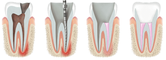 Endodoncja